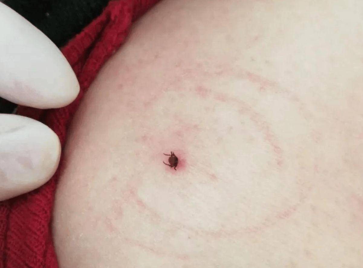 夏天孩子要警惕三种"毒虫",医生:轻则毁容,重则丧命