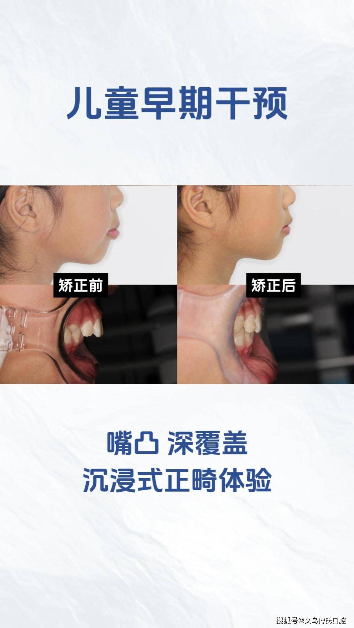儿童早期干预嘴凸深覆盖沉浸式正畸体验