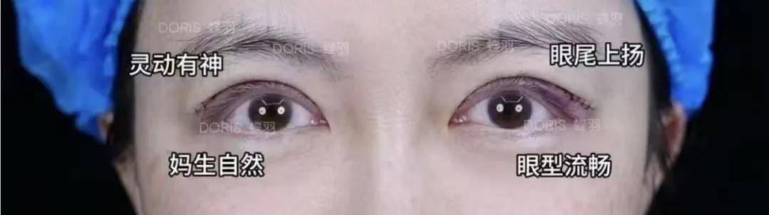 做了手术闭眼困难 瑞格医美楚院长的术后案例被曝修图后发布(图4)