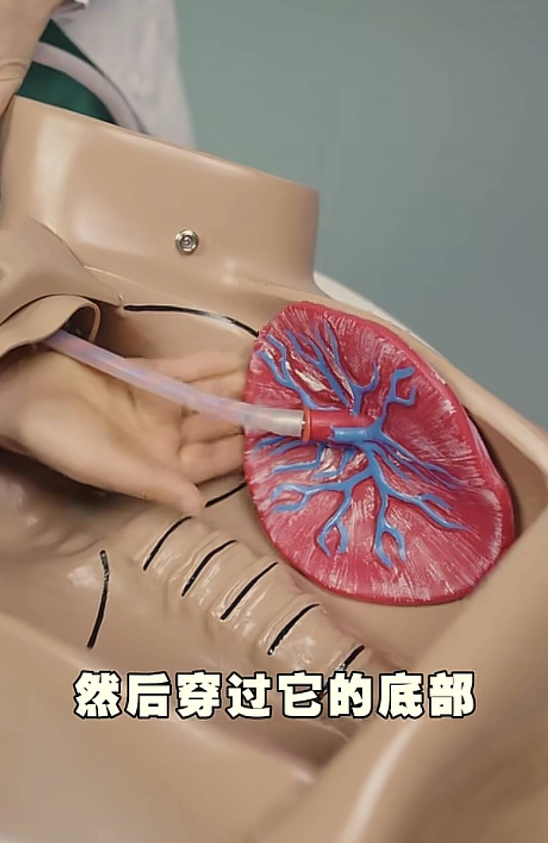 手剥胎盘为什么说大家都闻风丧胆呢？这个实操就告诉我们