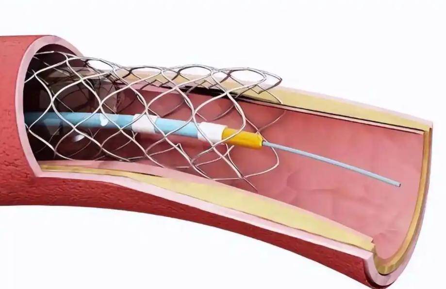 原创            胆固醇正常怎会心梗？美国心脏协会警示：此指标比坏胆固醇更具潜在风险