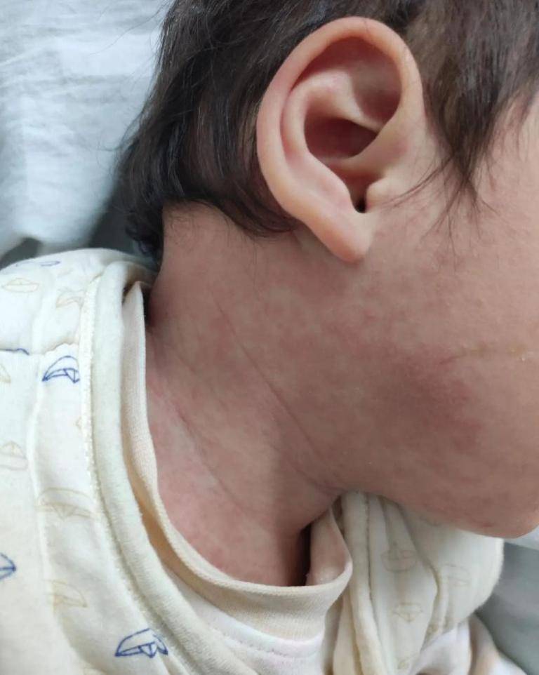 六个月孩子吃完辅食后起小红点,过敏？崔玉涛医生：三天法确定