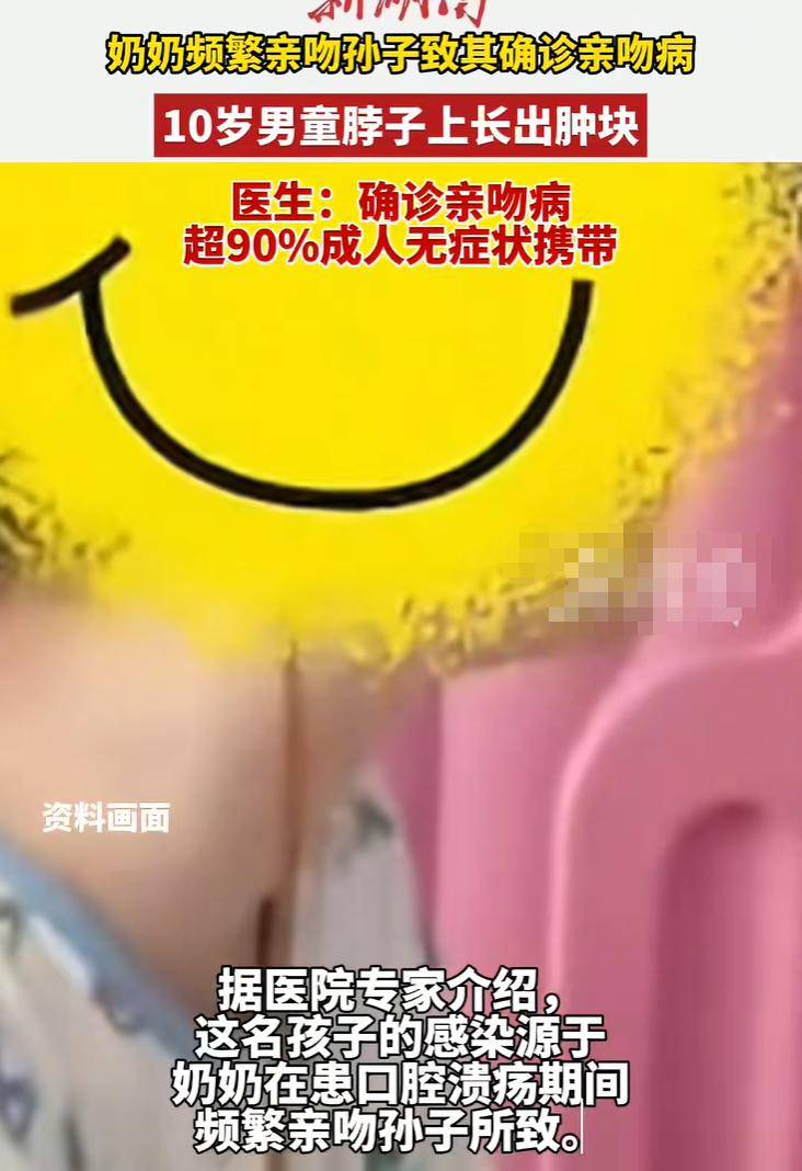 奶奶频繁亲吻孩子致其确诊亲吻病,导致10岁男孩脖子长肿块