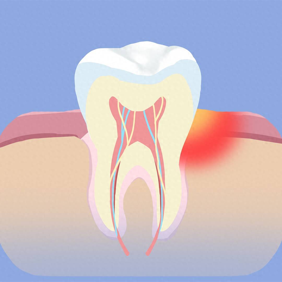 原创            牙龈出血不是上火！可能牙周炎在作怪，5类高危人群做好预防