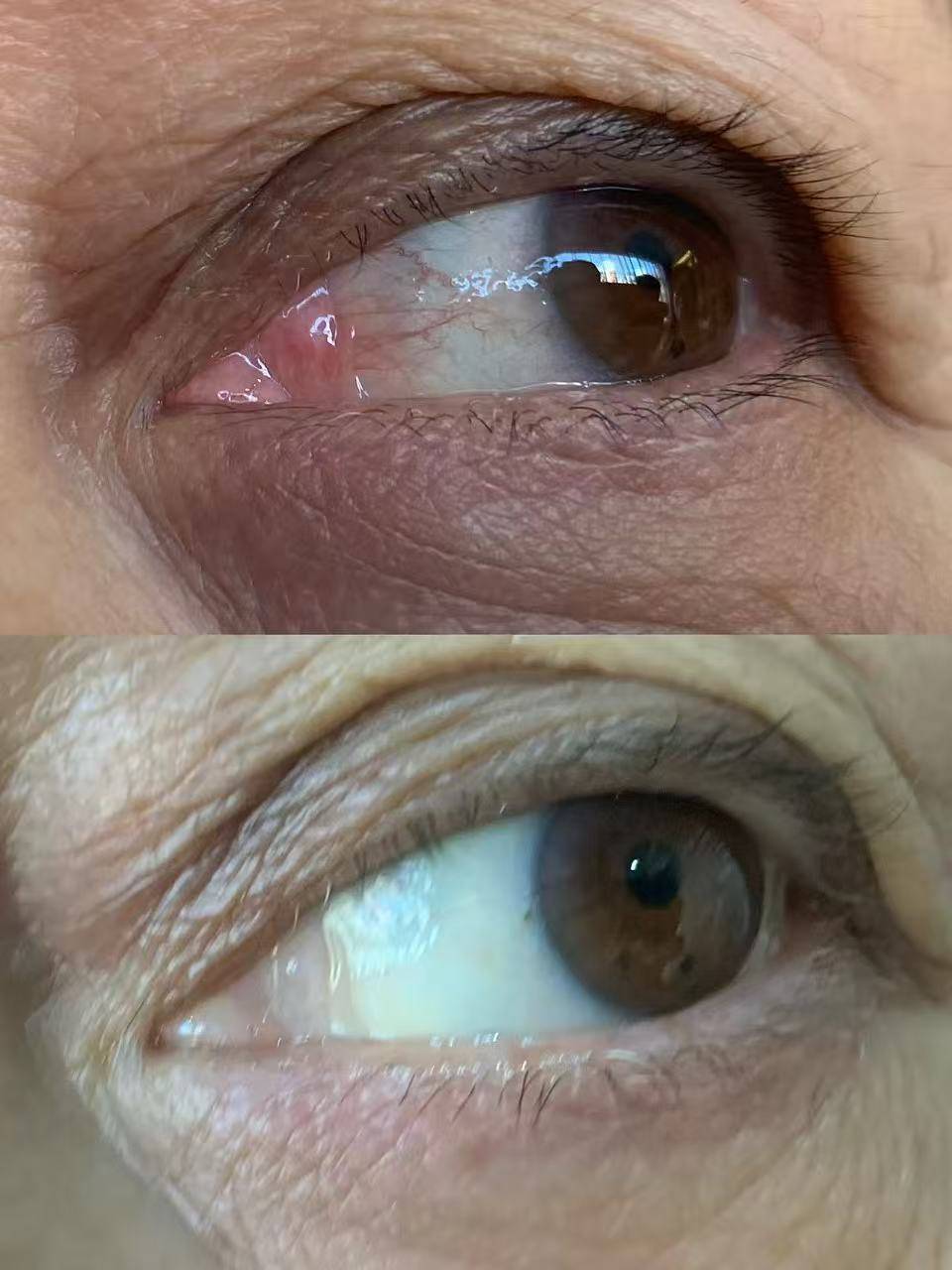 白眼球发黄发污怎么办?眼球抗衰