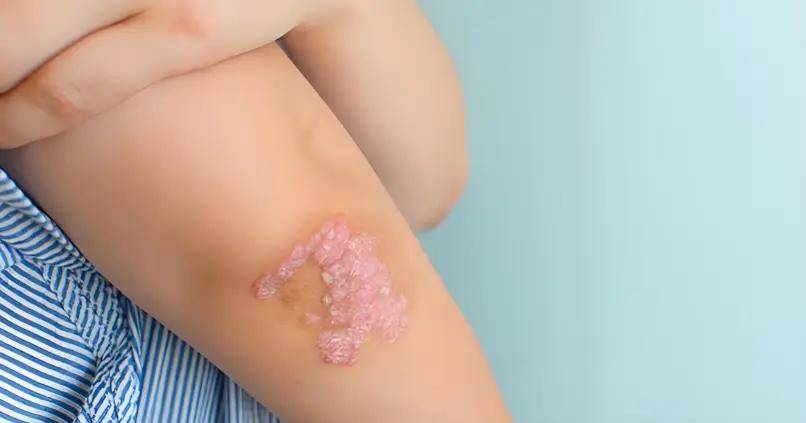 在银屑病治愈过程中，为什么用药安全比起效速度更重要？