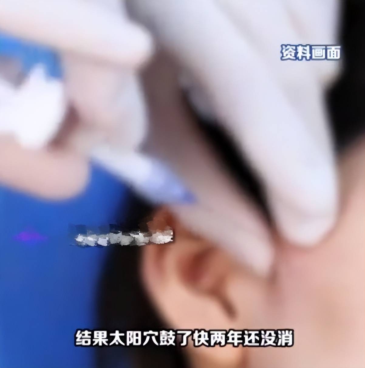 定制“头包脸”需谨慎:西安东方丽诚注射太阳穴被曝鼓大包(图3) get?code=NmM5NThhYjA2YTA3ODMzZjYwYzdkN2U2NjMzNDBjNzAsMTc3NDc0OTIyMDE1NA==