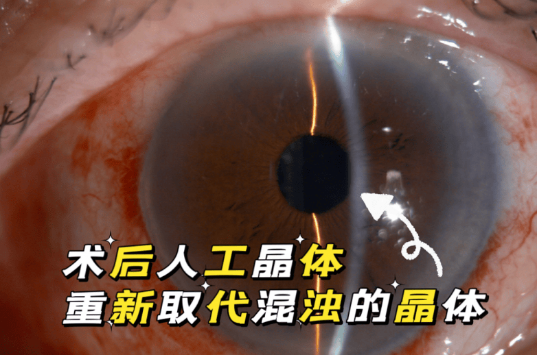 佛山爱尔眼科成功为八旬老人实施飞秒激光白内障联合三焦点晶体手术，术后视力达1.0(图1)