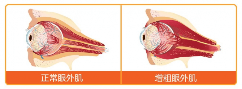 甲亢甲减致眼突,专病专治更靠谱—— 爱尔眼科22城33家甲状腺眼病专病门诊,开启精准诊疗时代!(图2) 甲亢甲减致眼突,专病专治更靠谱—— 爱尔眼科22城33家甲状腺眼病专病门诊,开启精准诊疗时代!(图2)