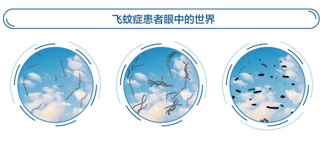 眼前总有小黑影飘？飞蚊症到底要不要治？