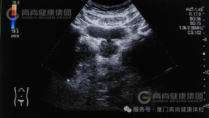 PSA指标升高别恐慌！一个向上箭头不等于前列腺癌