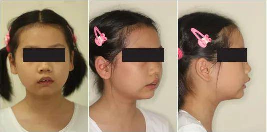 影响孩子颜值的龅牙问题，如何做好预防和矫正？