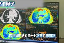 提升疾病早期检出率 内江一院光谱CT正式投入使用