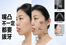 嘴凸矫正，不一定非要拔牙，要看这是哪个维度