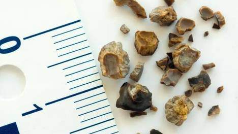 肾结石拼命跳绳？当心越跳越卡！医生：这几种情况跳了要命