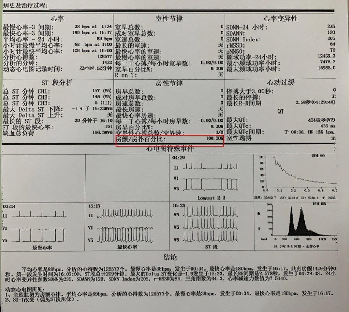 66岁大妈切息肉意外发现房颤,52岁大叔气促被误当心肌病肺炎