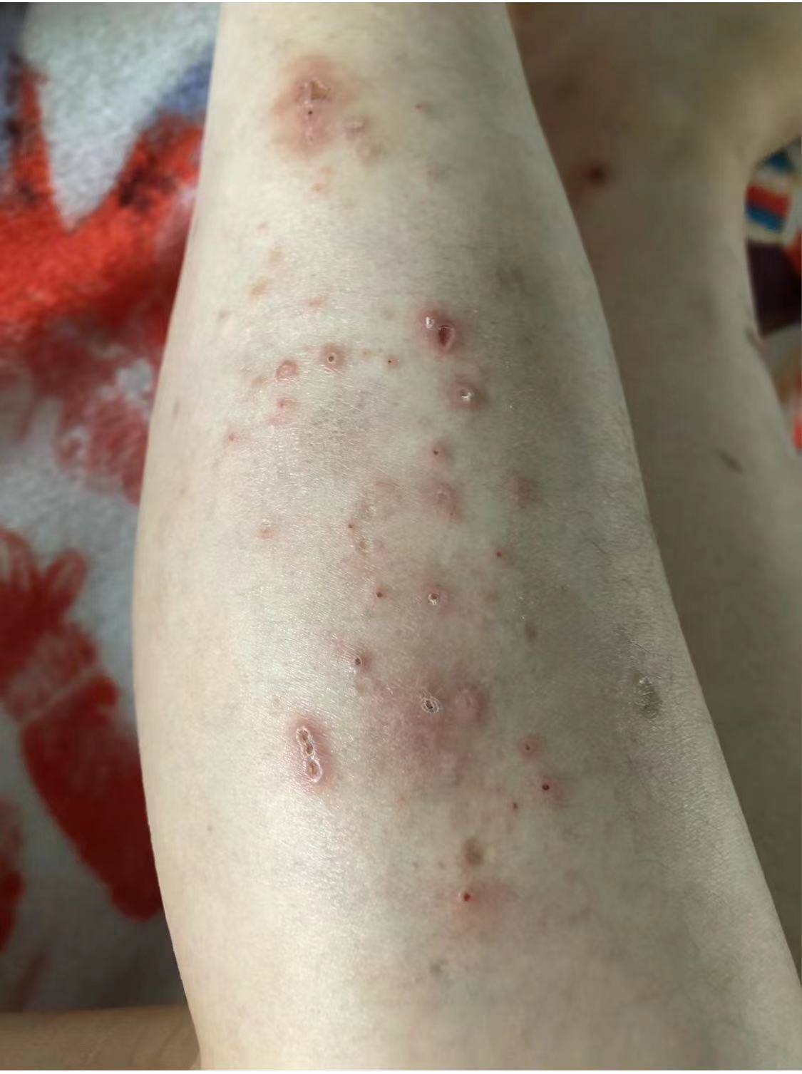 每天坚持这样去做,身上的红疹消失啦,皮肤也不痒了,真的有用_方法