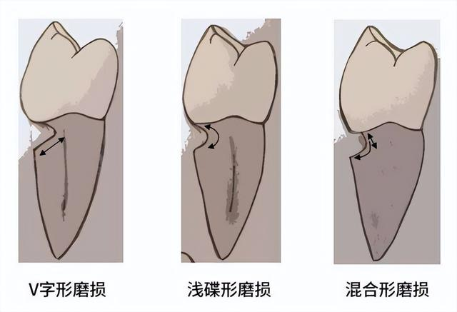 楔状缺损是什么样子的图片