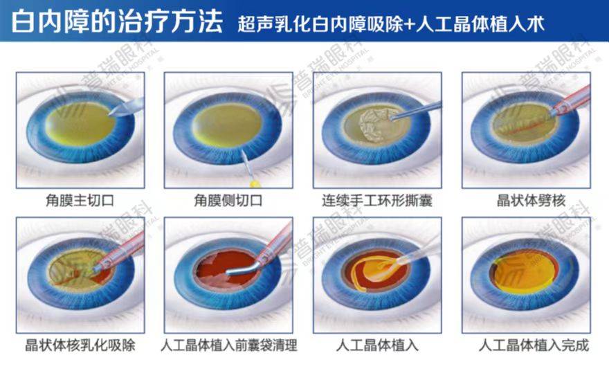 武汉普瑞眼科医院关于白内障的20条干货一定要看_手术_晶状体_视力