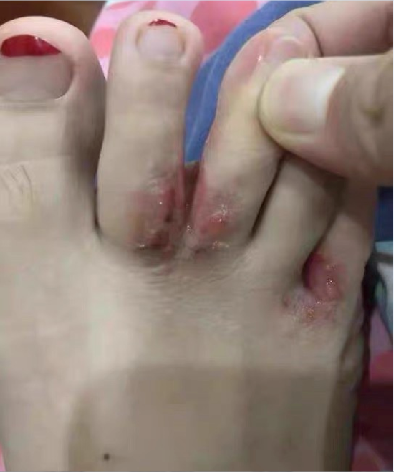 对于脚汗多和脚臭的人,建议每周3~4天在温水里放一片高锰酸钾,不仅