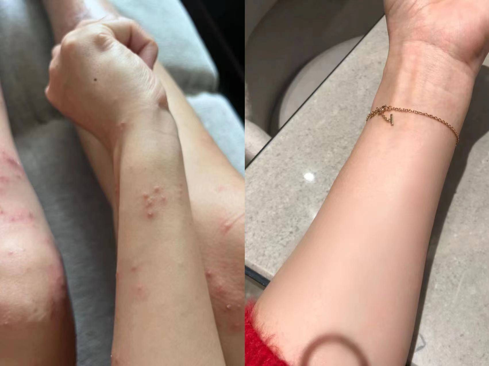 皮肤还是长红疹瘙痒,试试这三个方法,30天恢复好皮肤_严重_关键_药膏