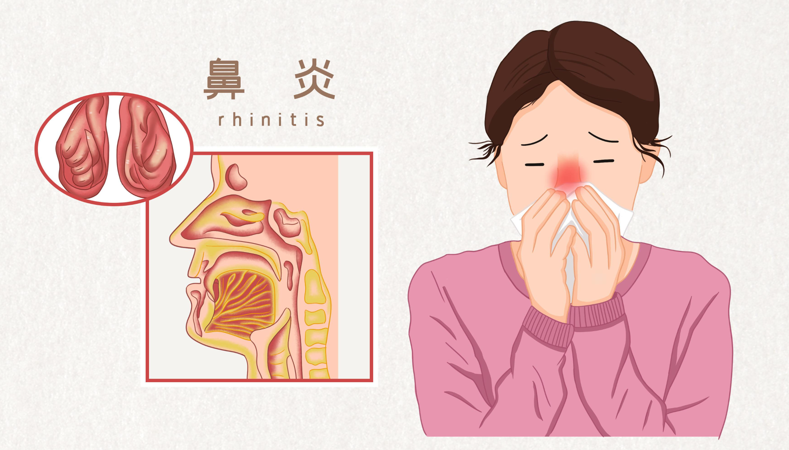 瑞丽康:春季到,过敏性鼻炎发作,该如何是好?_孟鲁司特钠