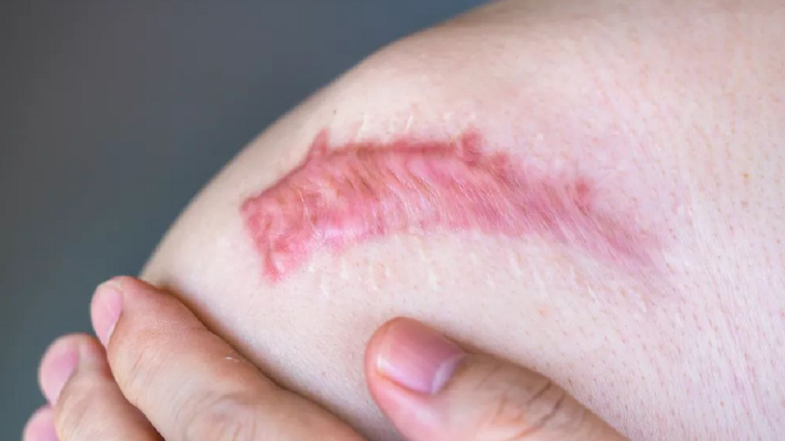 疤痕自查!专业人士现身科普!看看你属于哪种?