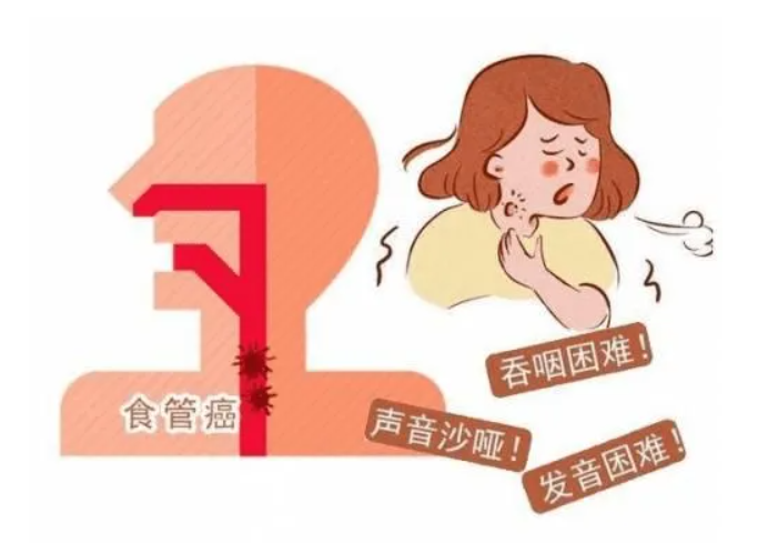 这些身体预警，你重视了吗？ 一、进行性吞咽困难。这样的情况会随着时间的推移而逐步加重