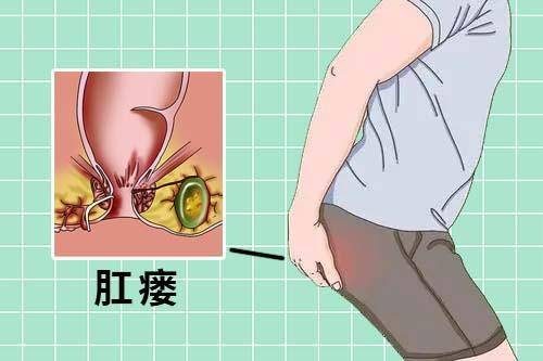 道县新区医院肛肠科为什么得肛瘘