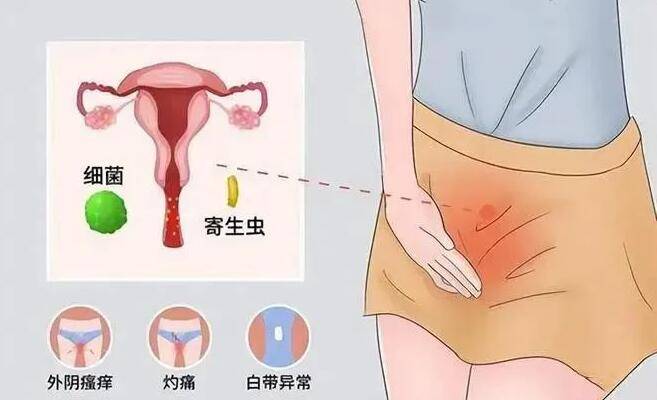 女人的阴虱的早期症状图片