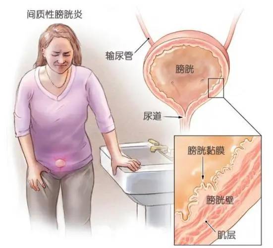 放射性膀胱炎图片图片