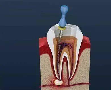 根管治疗是什么意思