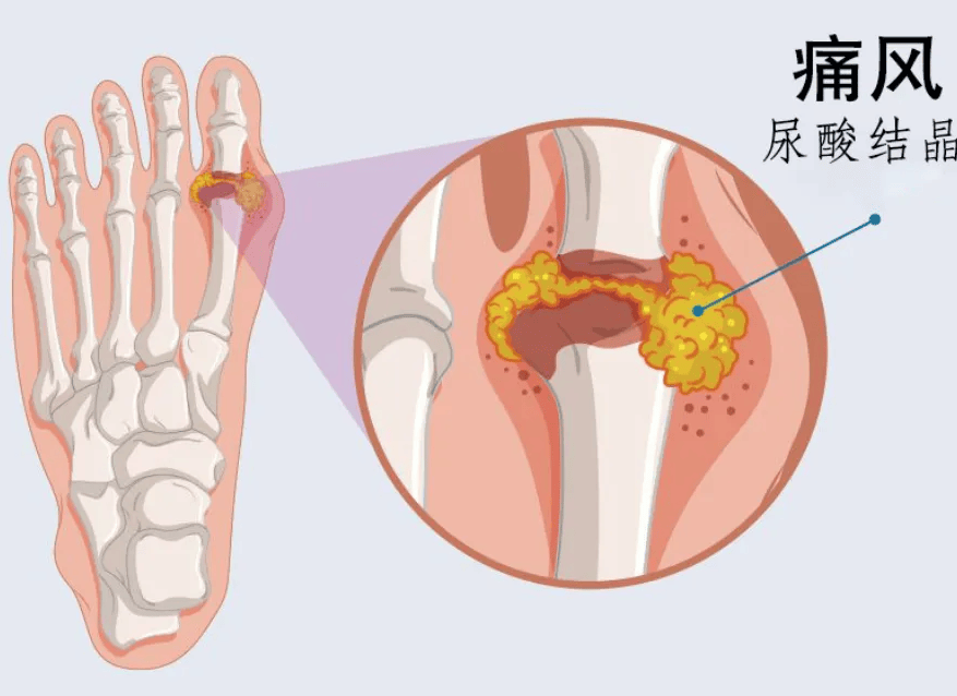 如何缓解痛风药物副作用造成的拉肚子日常护理技巧解决尿酸高问题