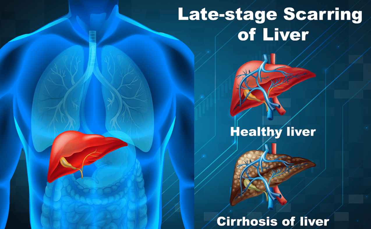 是正常肝细胞被纤维化组织所代替,造成肝脏结构重组和血管循环障碍
