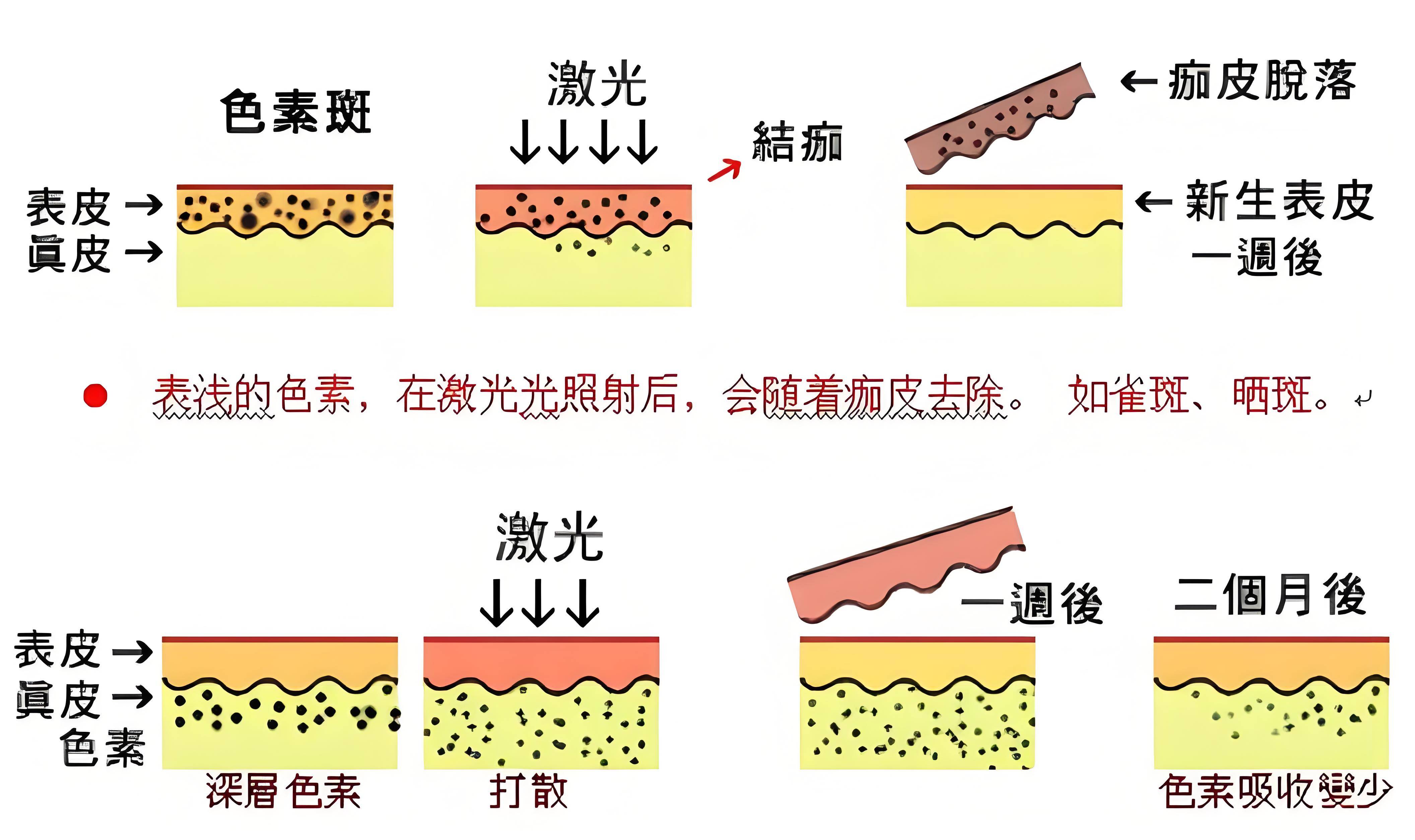 整形医生张武解析祛雀斑:光子嫩肤,激光,谁更有效?