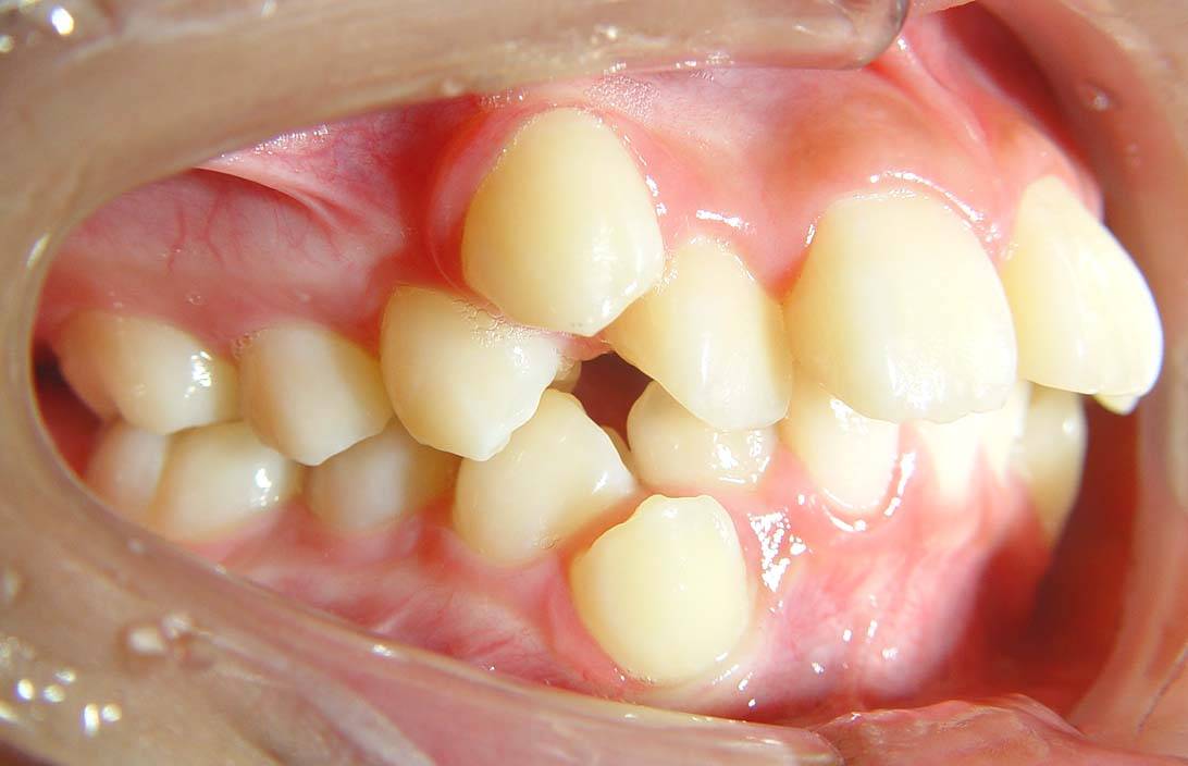 邢台资深种植牙专家:多生牙不拔有什么后果?