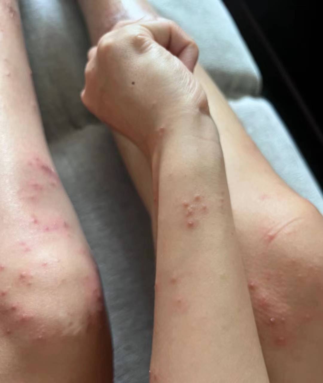 还为夏季皮肤红疹感到发愁吗?三个方法解决,赶紧收藏!