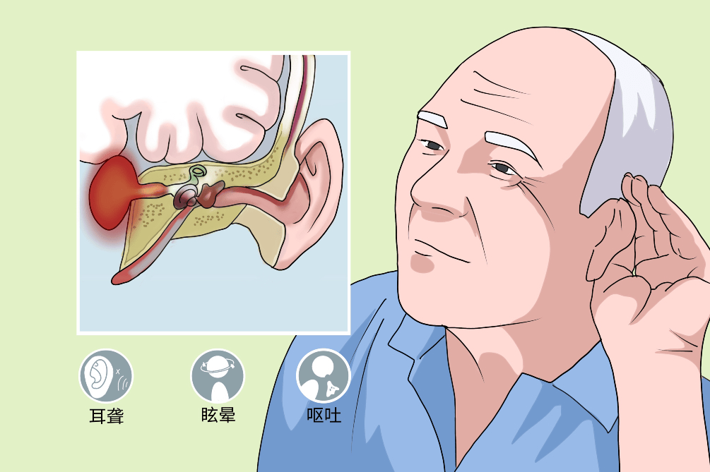 听神经瘤对患者神经功能的影响