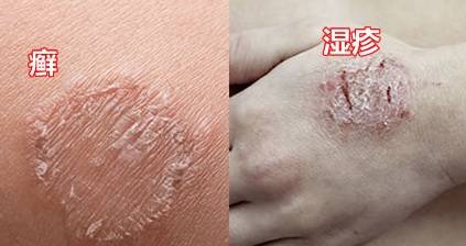 夏季皮肤病高峰期:防范与治疗并重_阳光_症状_衣物