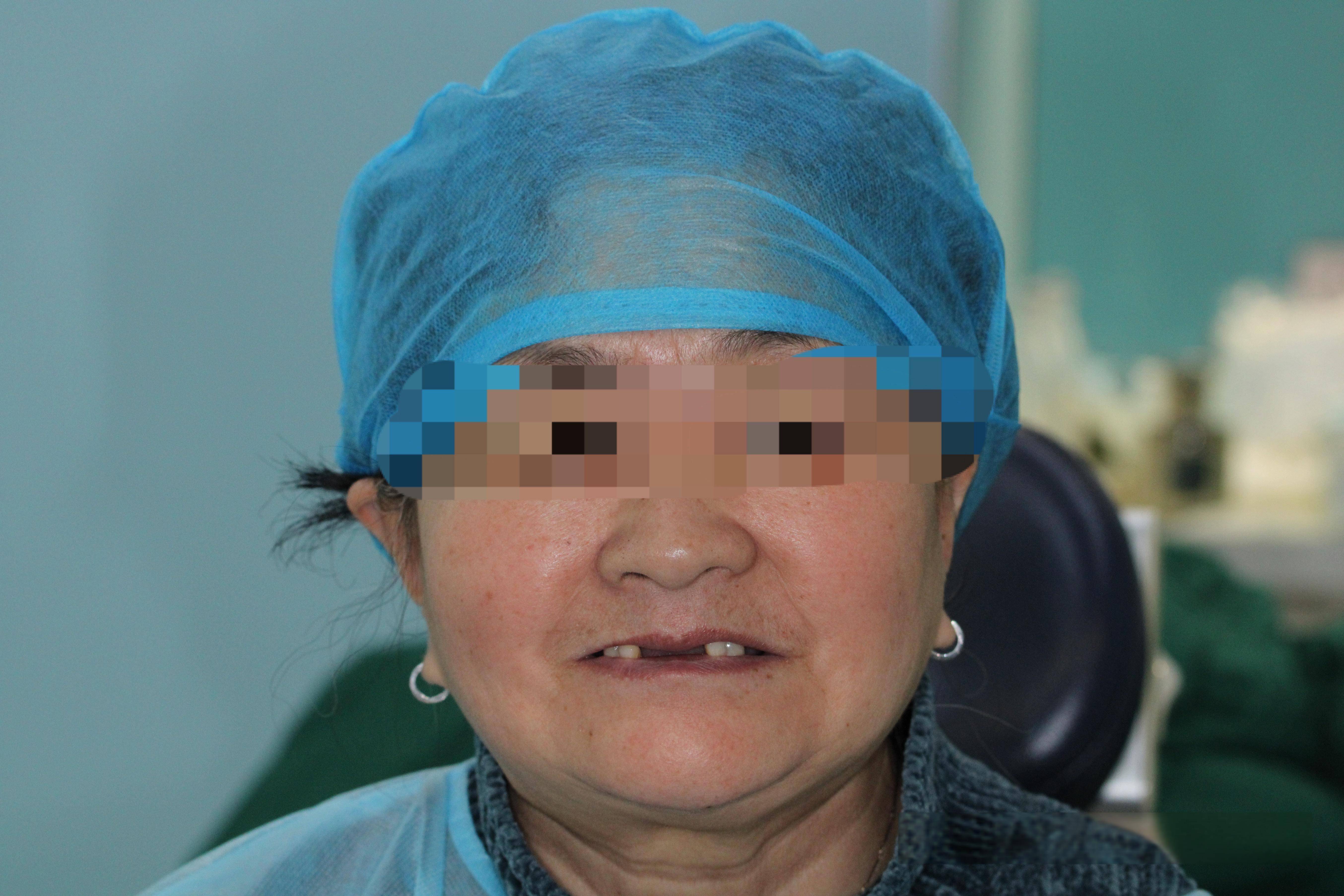 在邢台半口种植牙,仅用6颗植体,就撑起一排好牙