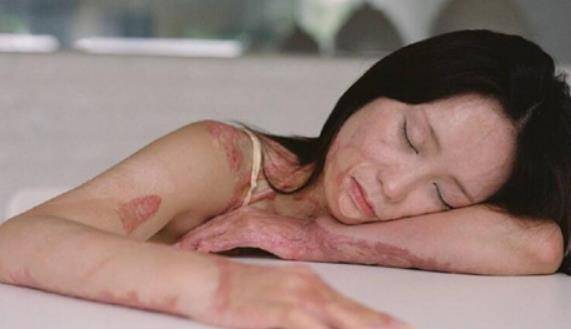 16岁少女周岩,因拒绝同学追求惨被毁容,她如今怎么样了?