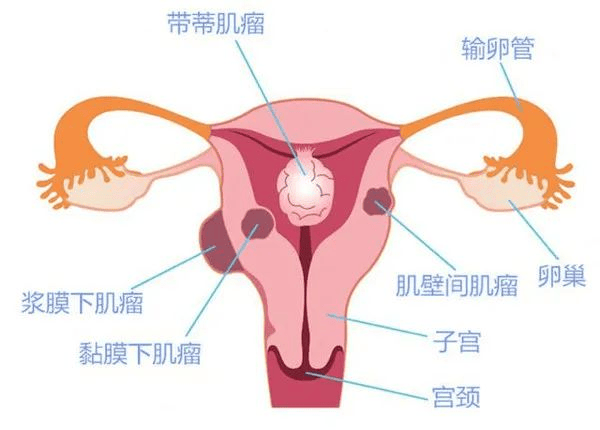 子宫肌瘤的临床表现有哪些？怎样治疗？