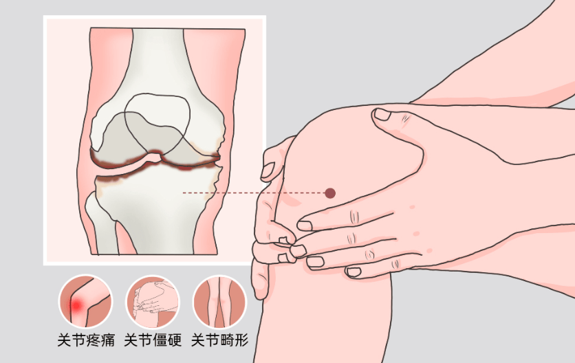 十字韧带疼图片