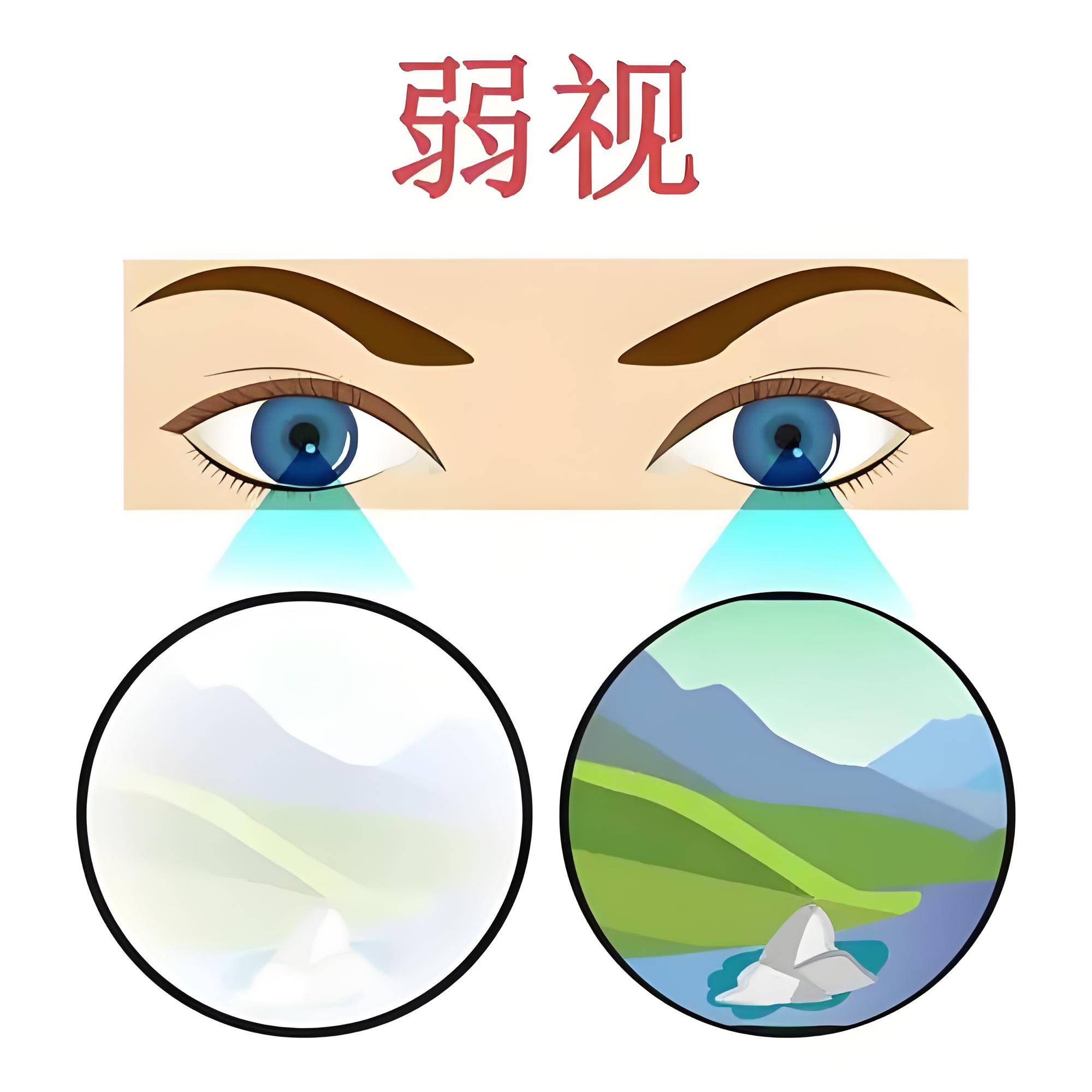 弱视康复路上的新选择——亲历者分享中医康复的真实效果