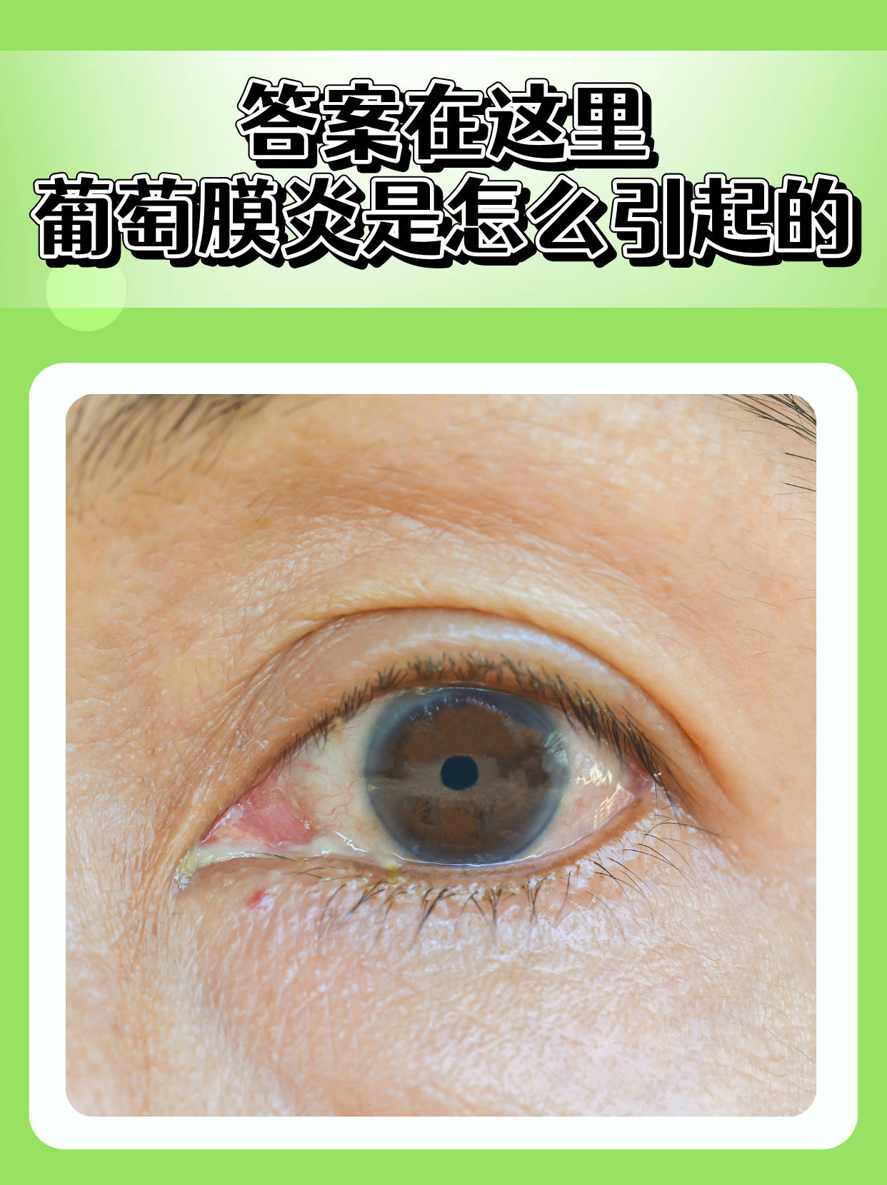 答案在这里:葡萄膜炎是怎么引起的?