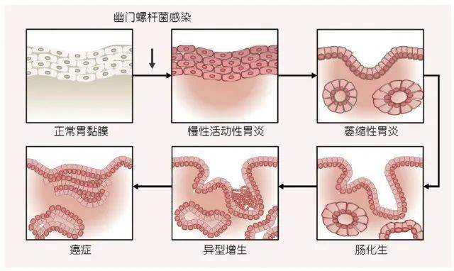 又是幽門螺桿菌