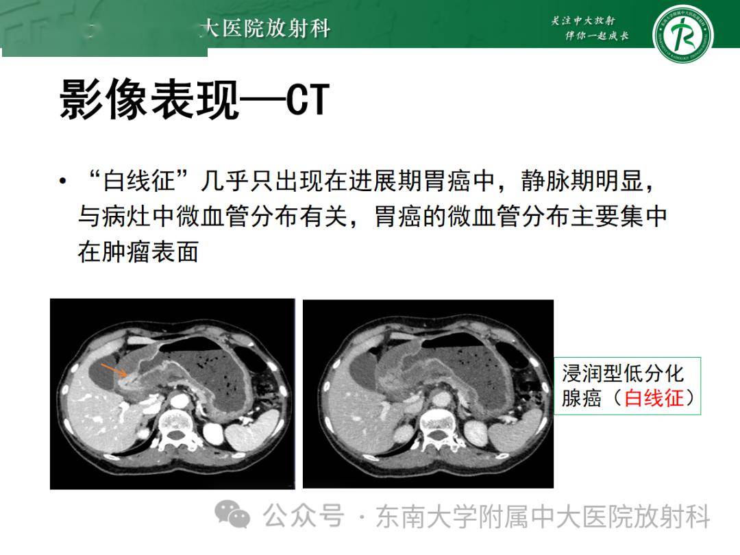 胃黏膜相關淋巴組織(malt)淋巴瘤_全網_影像_解剖圖