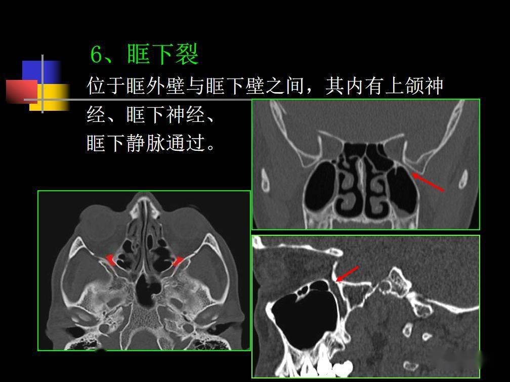 人體鼻咽部及ct的詳細解剖圖分析_全網_影像_淋巴