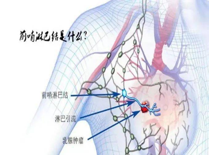 乳腺前哨淋巴结的位置图片