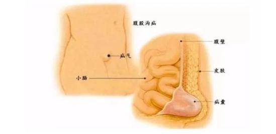 腹股沟疝一定要手术治疗吗?